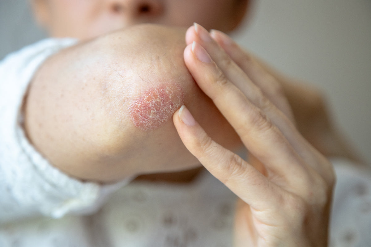 Hvordan roe ned psoriasis og eksem naturlig